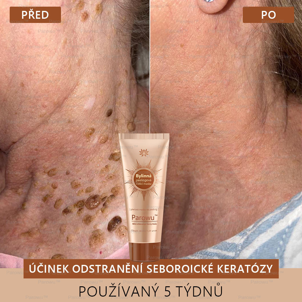 🎁 Parowu™ Bělící a Odstraňující Skvrny Maska -🍀 🎁